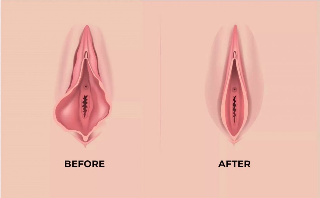 Before and After Laser Vaginal Tightening